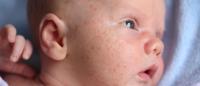 newbown's face with baby acne